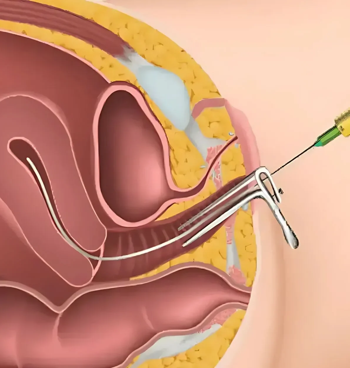 Affordable IUI Treatment in Uttam Nagar